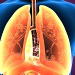 Understanding Eosinophilic Asthma: Symptoms, Causes, and Treatment eosinophilic asthma