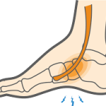 Extensor Tendonitis: Causes, Symptoms, and Effective Treatments extensor tendonitis