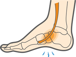 extensor tendonitis