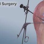 Meniscus Tear Surgery: A Comprehensive Guide to Recovery and Relief meniscus tear surgery