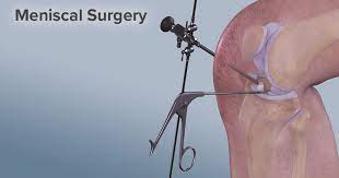 meniscus tear surgery