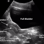 Pelvic Ultrasound: A Non-Invasive Imaging Tool for Female Health pelvic ultrasound