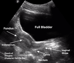 Pelvic Ultrasound: A Non-Invasive Imaging Tool for Female Health ...