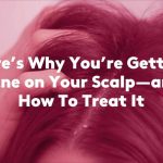 Treating Pimples on the Scalp: Causes, Remedies, and Prevention pimples on scalp