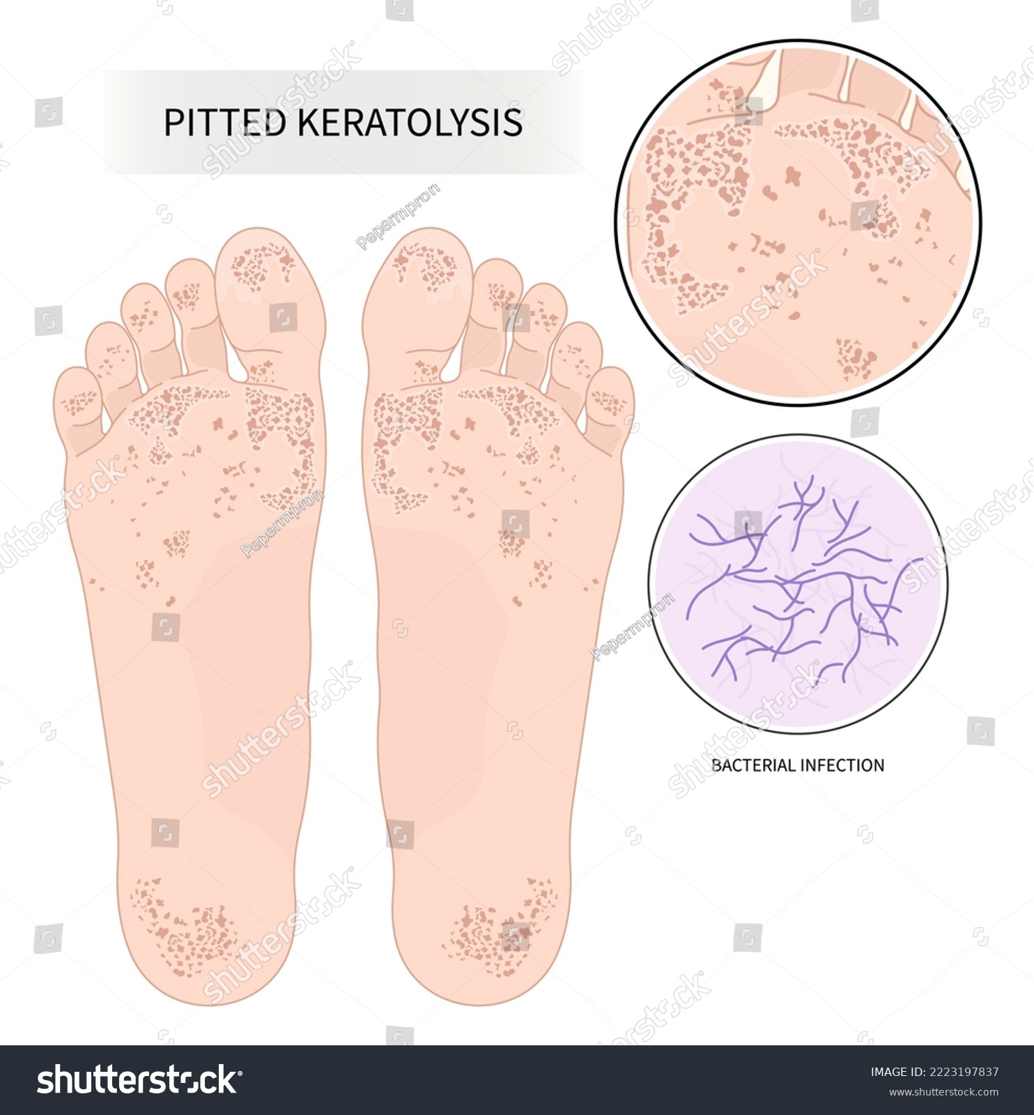 pitted keratolysis