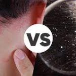Scalp Psoriasis vs. Dandruff: Understanding the Key Differences for Effective Treatment scalp psoriasis vs dandruff
