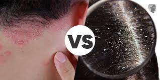 Scalp Psoriasis vs. Dandruff: Understanding the Key Differences for ...