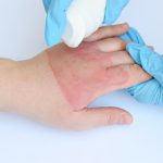 The Unseen Dangers: Navigating the Complexities of 4th Degree Burns 4th degree burn