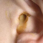 Drainage from Ear: Causes, Symptoms, and Treatment Drainage from Ear