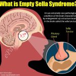 How to Lose Weight with Empty Sella Syndrome How to Lose Weight with Empty Sella Syndrome