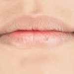 Eczema on Lips: Causes, Symptoms, and Effective Treatment Options Lip skincare routine