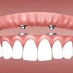 The Future of Dental Care: A Comprehensive Guide to Magnetic Dentures Magnetic Dentures