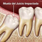 Todo lo que Debes Saber sobre las Muelas del Juicio: Información Completa Muelas del Juicio