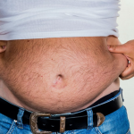 Understanding Apron Belly: Causes, Effects, and Ways to Manage apron belly