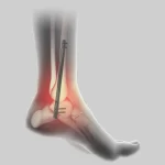 Arthrodesis Explained: Joint Fusion Surgery for Improved Mobility arthrodesis