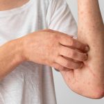 Atopy Uncovered: Exploring Allergic Skin Conditions and Solutions atopy