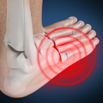 Comprehensive Guide to Avulsion Fracture: Causes, Symptoms, and Recovery avulsion fracture