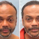 The Secrets: Is There a Real Bald Cure? bald cure