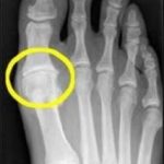 Big Toe Numbness: Causes, Symptoms, and Remedies big toe numb