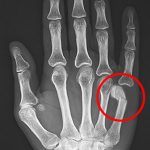 Boxer’s Fracture: Causes, Symptoms, and Treatment Explained boxers fracture