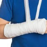Dealing with a Broken Arm: From Diagnosis to Recovery broken arm