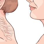 Understanding Buffalo Hump: Causes, Management, and Prevention buffalo hump