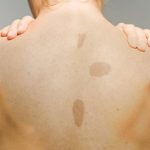 Café au Lait Spots: Causes, Appearance, and Treatment cafe au lait spots