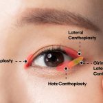 Canthoplasty: Enhancing Eye Aesthetics with Precision canthoplasty