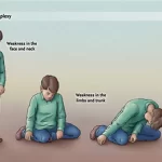 Cataplexy: Unveiling the Intricacies of Sudden Muscle Weakness cataplexy