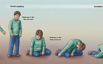 cataplexy