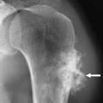 Decoding Chondrosarcoma: Causes, Symptoms, and Treatment Options chondrosarcoma