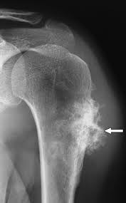 chondrosarcoma