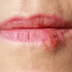 Differentiating Cold Sore vs Herpes: Causes, Symptoms, and Treatment cold sore vs herpes