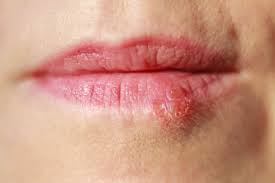 cold sore vs herpes