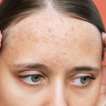 Decoding Comedonal Acne: Causes, Treatment, and Prevention Strategies comedonal acne