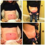 CoolSculpting Reviews for Your Body Transformation coolsculpting reviews