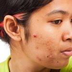 Dapsone: Uses, Benefits, and Considerations for Effective Treatment dapsone
