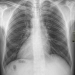 Demystifying Dextrocardia: Understanding the Reversed Heart Condition dextrocardia