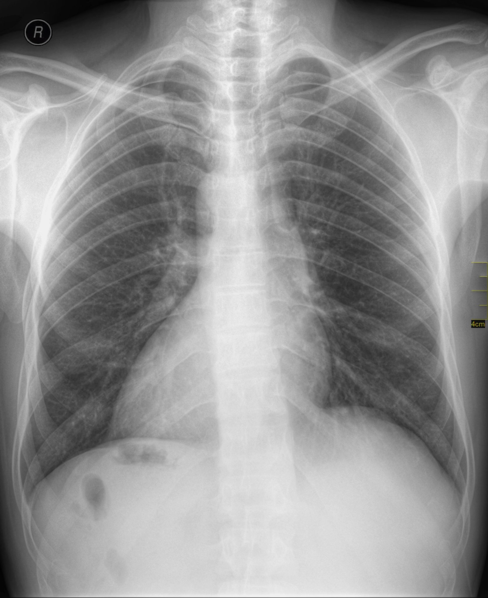 Dextrocardia: Understanding the Reversed Heart Condition