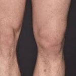 Navigating Dislocated Kneecap: Causes, Symptoms, and Recovery dislocated kneecap