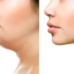 Double Chin Removal: Effective Techniques and Options double chin removal