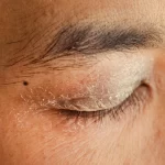 Understanding Dry Eyelids: Causes, Symptoms, and Relief dry eyelids