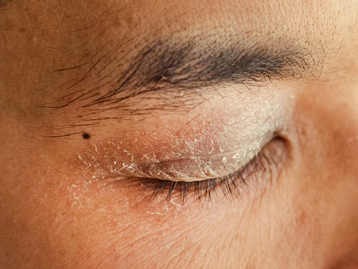 Understanding Dry Eyelids Causes Symptoms And Relief