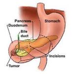 Diving Deeper into Duodenal Cancer: Causes, Symptoms, and Treatment duodenal cancer