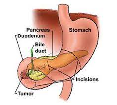 duodenal cancer