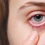 Managing Eczema Around Eyes: Causes, Treatments, and Care eczema around eyes