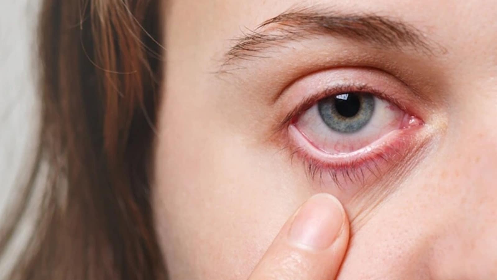 eczema around eyes