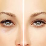 Transform Your Look with an Eye Lift: What You Need to Know eye lift