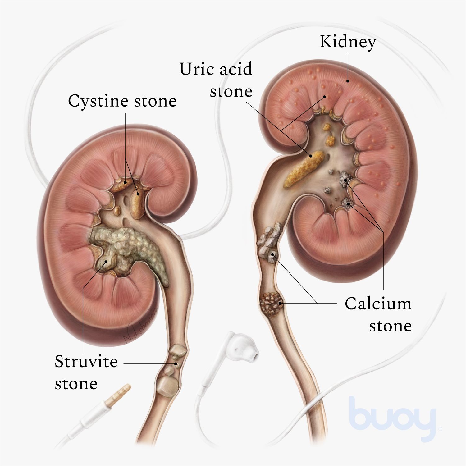 flomax for kidney stones