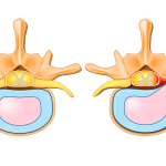 Foraminal Stenosis: Causes, Symptoms, Diagnosis, and Treatment foraminal stenosis